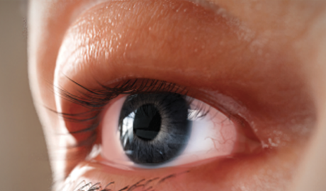 Swollen and puffy eyelids from Thyroid Eye Disease