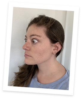 Side view of Bonnie before her first TEPEZZA treatment for Thyroid Eye Disease