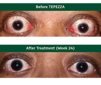 Eyes before and after TEPEZZA 1