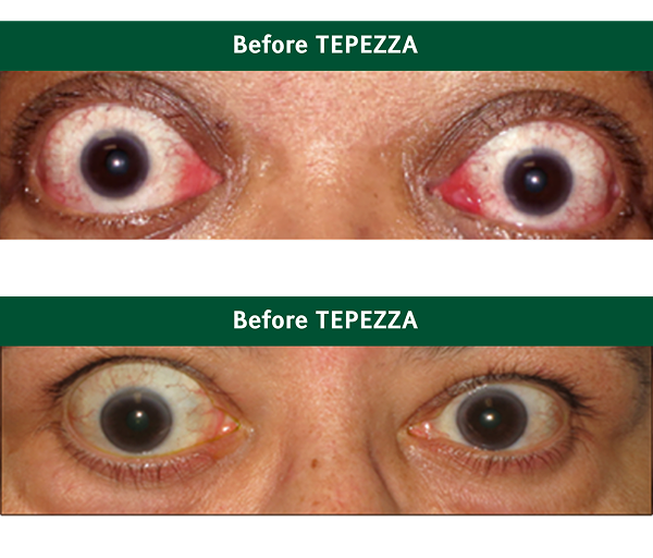 Eyes before and after TEPEZZA 1