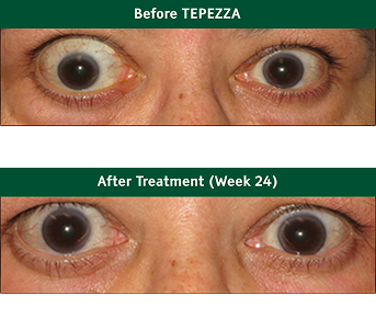 Eyes before and after TEPEZZA 2