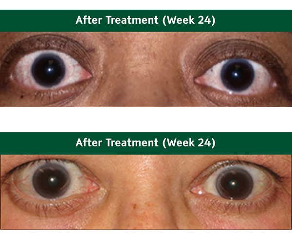 Eyes before and after TEPEZZA 2