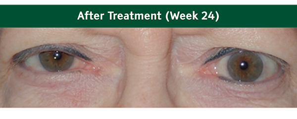 Eyes after treatment (week 24)