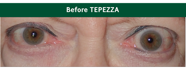 Eyes before TEPEZZA