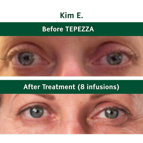 Kim E. before and after TEPEZZA treatment (8 infusions)