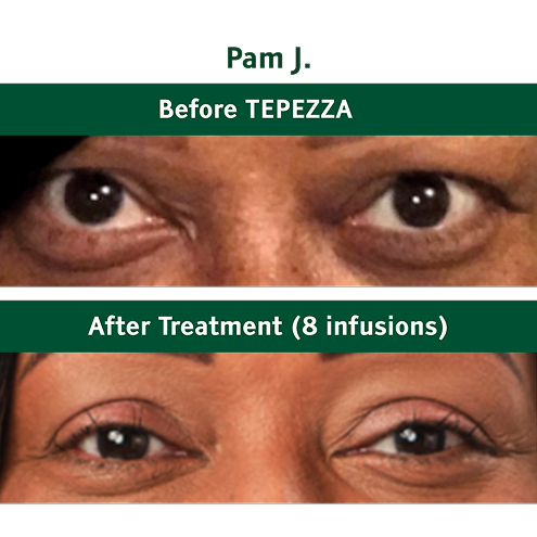 Pam J. before and after TEPEZZA treatment (8 infusions)